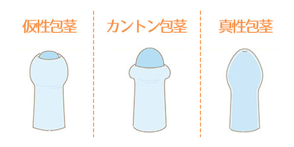 包茎3種類