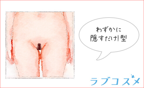 I型のアンダーヘア